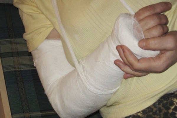 30-летняя калужанка сломала руку об поезд 